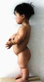 Achondroplasia - genetic disorder - dwarfism, symptoms and treatment