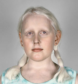 albino eyes blue