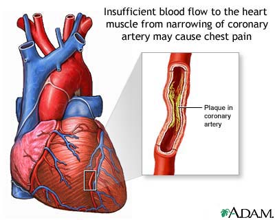 angina symptoms