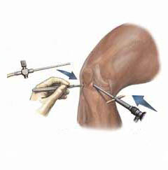 Arthroscopy procedure / surgery