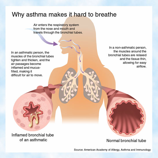 airway asthma