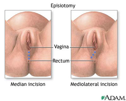 Episiotomy Complications