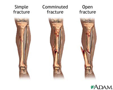 Fracture of bone - types, symptoms and treatment