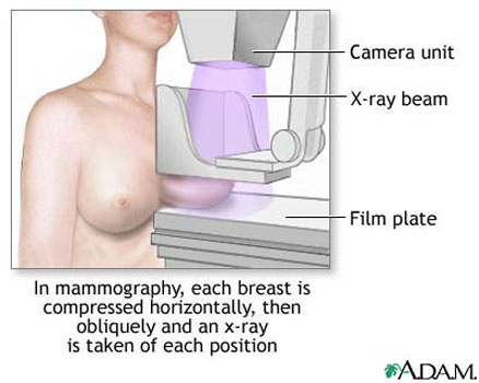 Mammogram - diagnostic, procedure