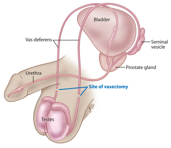 Vasectomy surgical Procedure